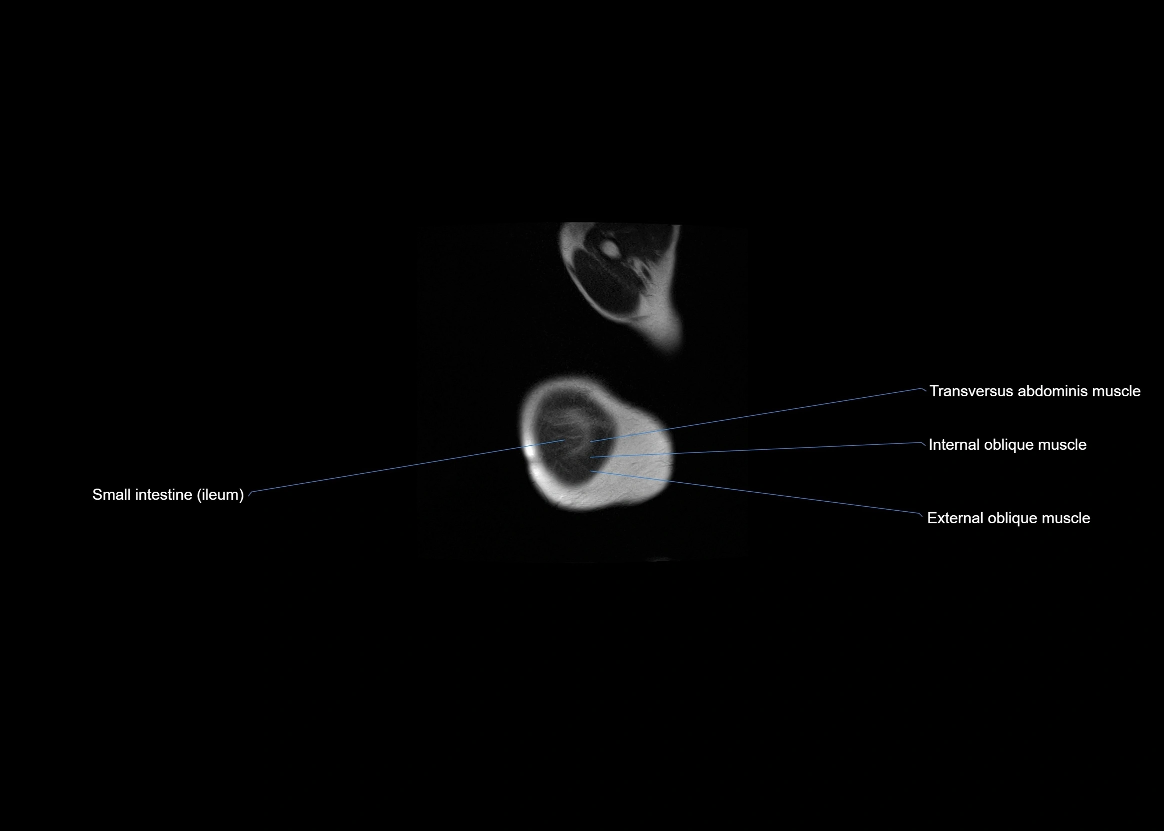 MRI abdomen sagittal cross sectional anatomy  radiology  image-img-00001-00001.webp